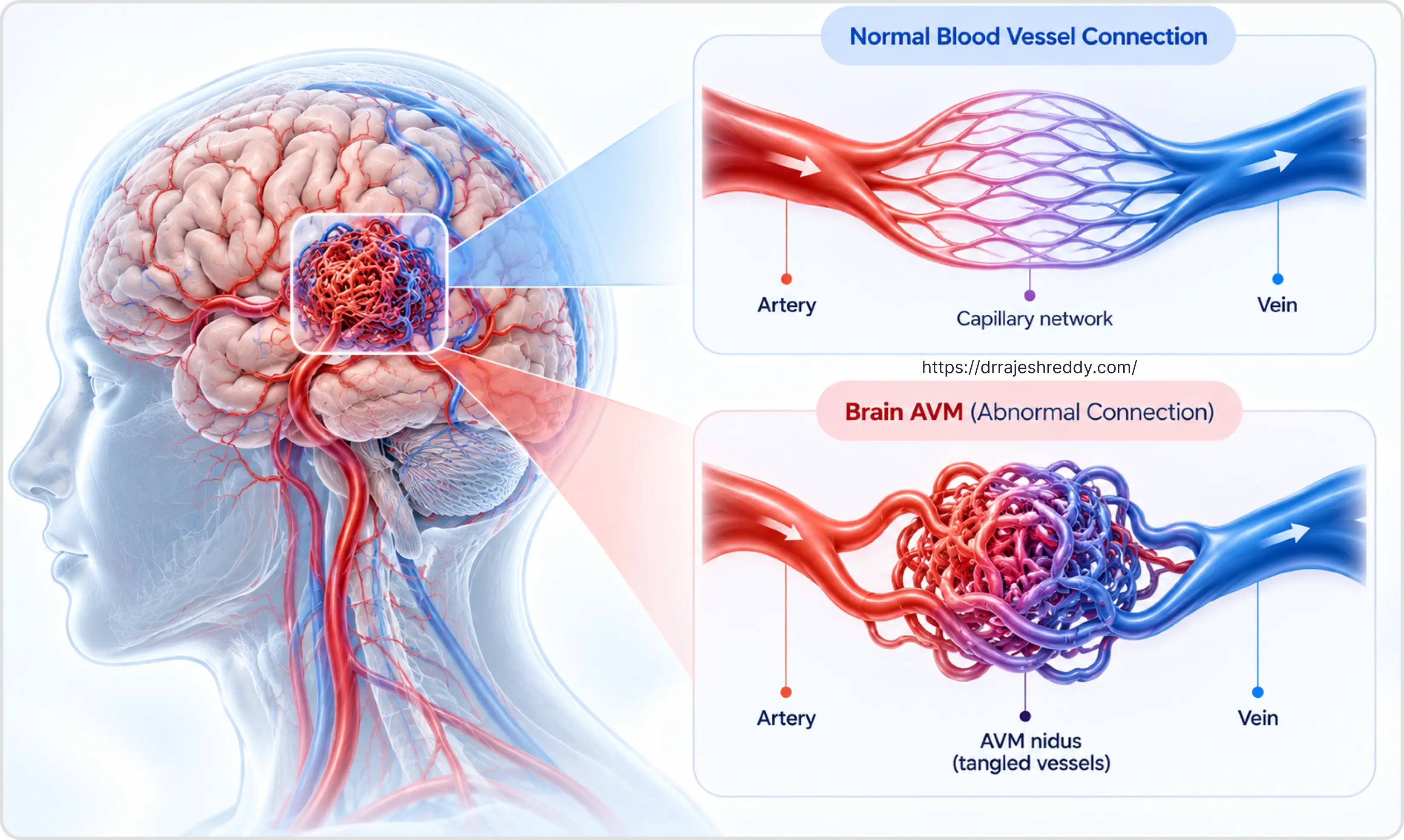 Brain AVM