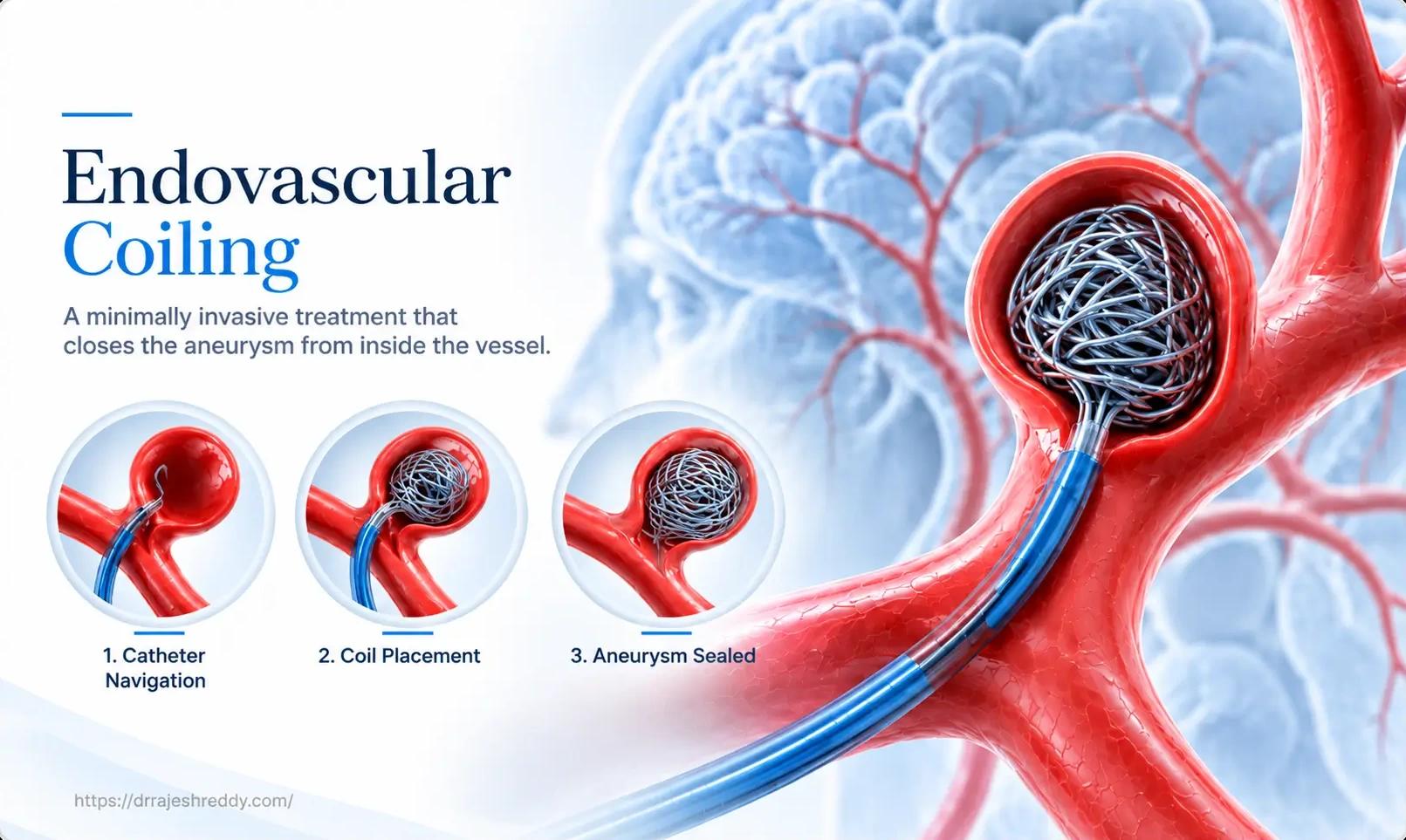 Endovascular Coiling Procedure
