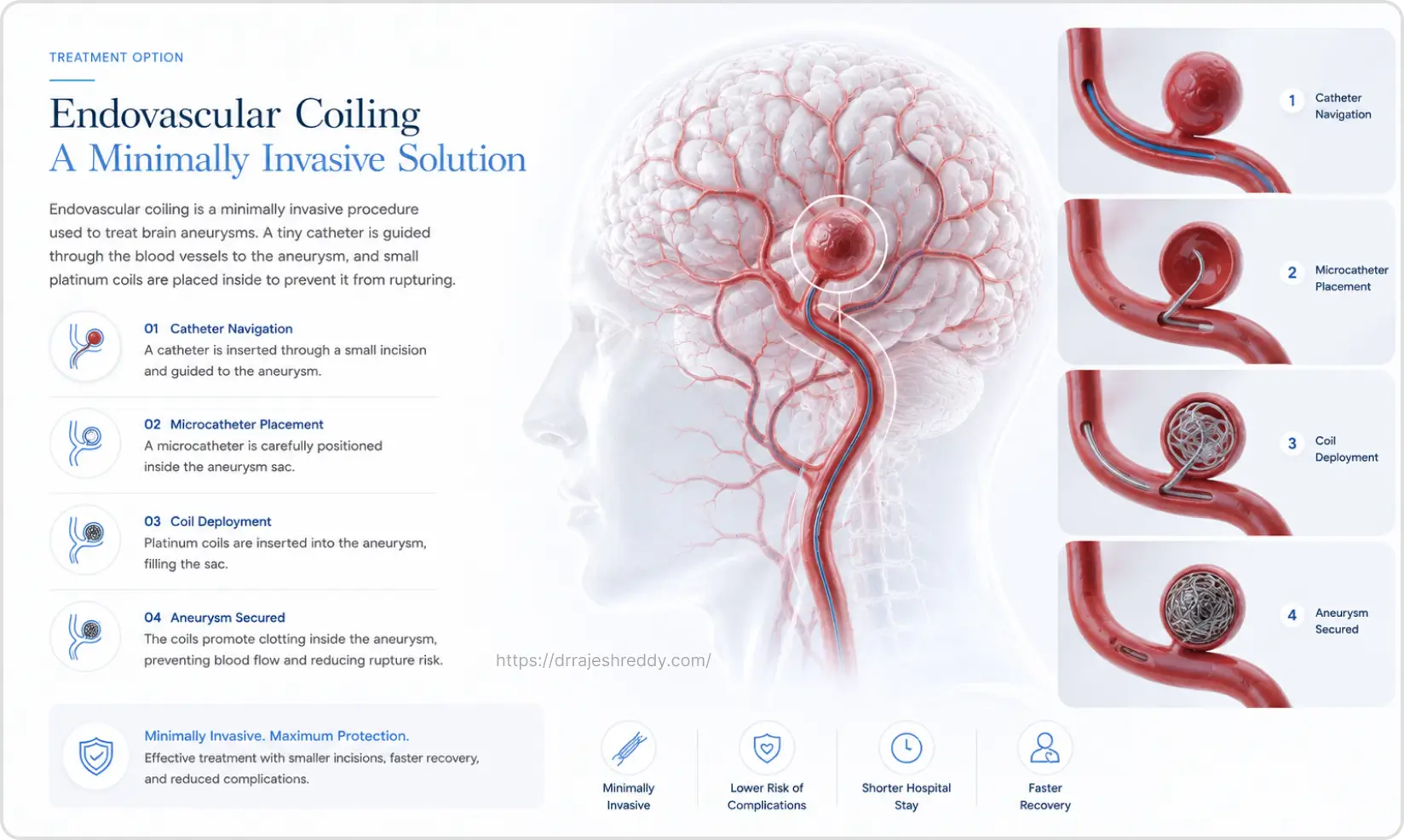 Endovascular Coiling Treatment