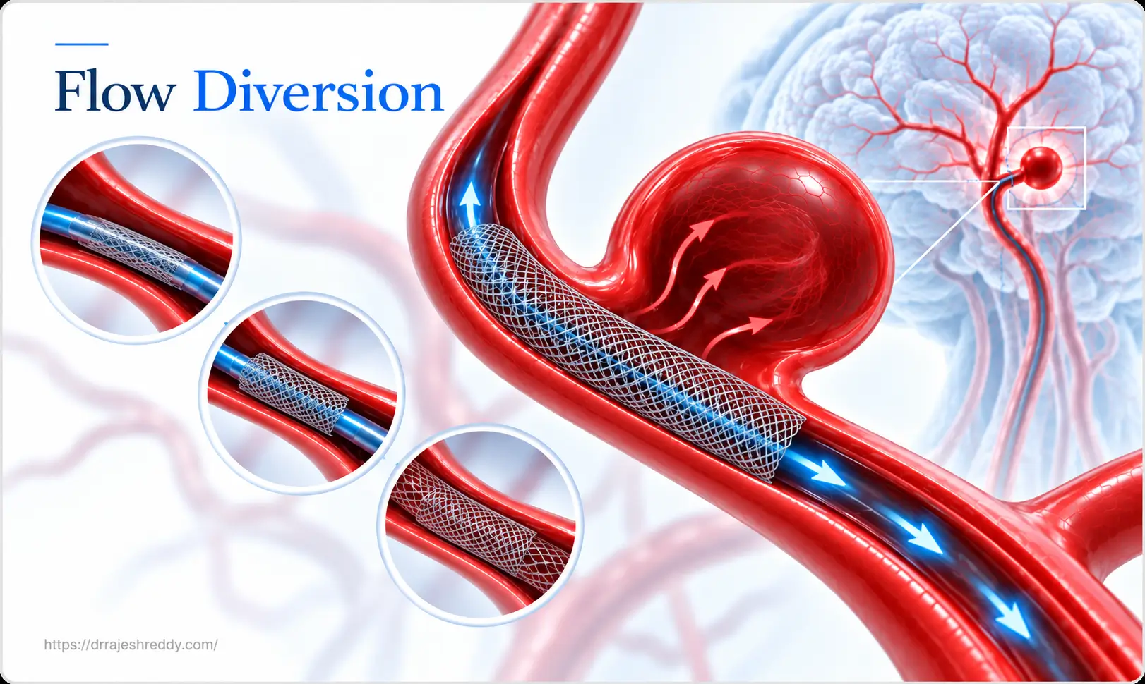 Consult Dr. Rajesh Reddy for Flow Diversion Evaluation