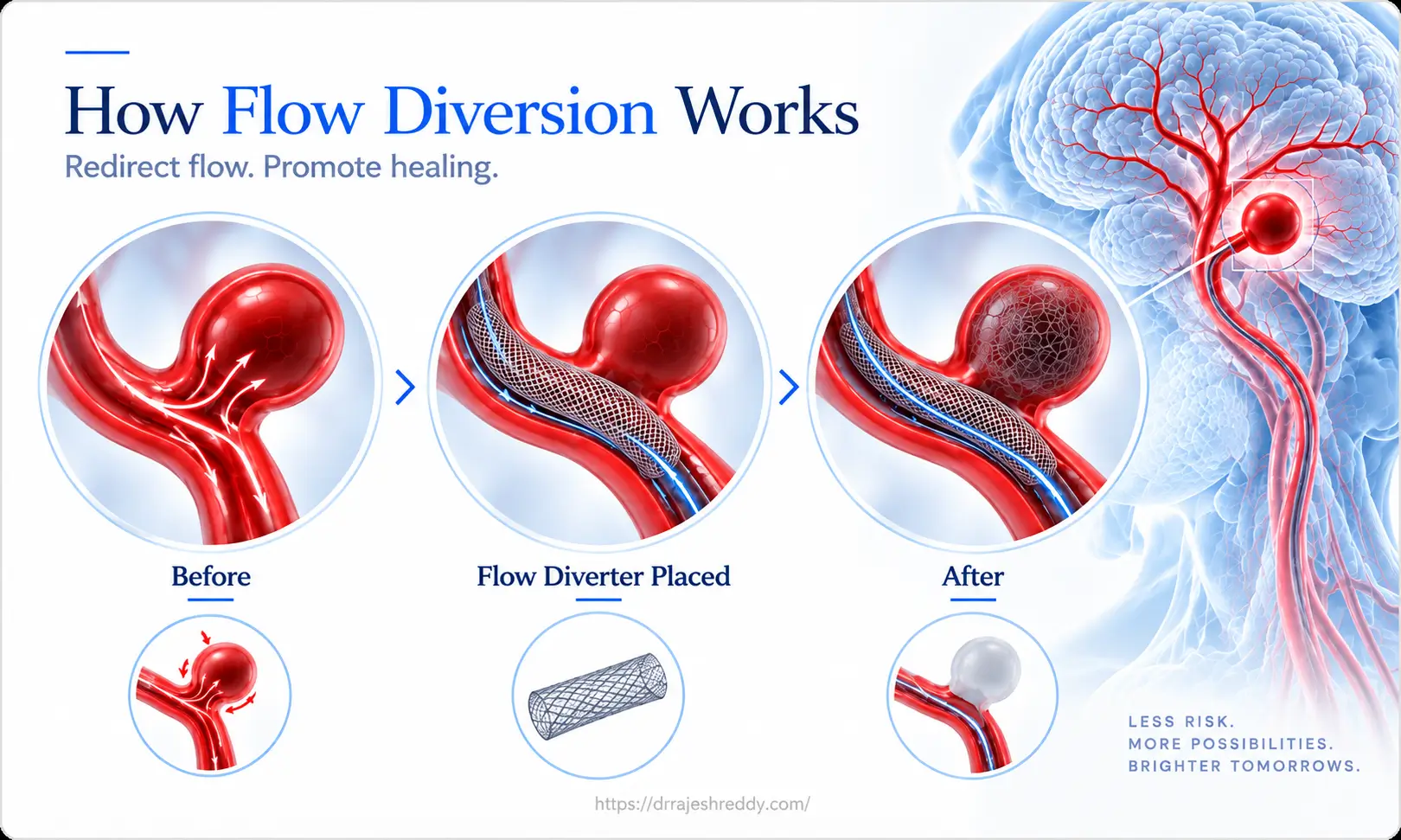 How Flow Diversion Works for Brain Aneurysms