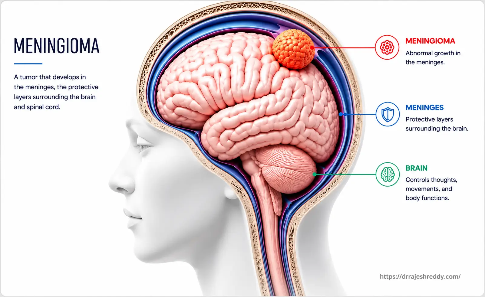 Meningioma Treatment Options Comparison