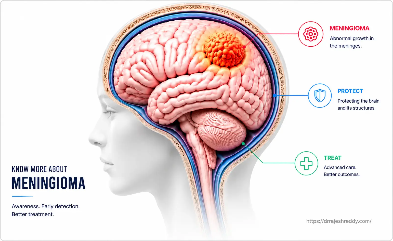 Understanding Meningiomas