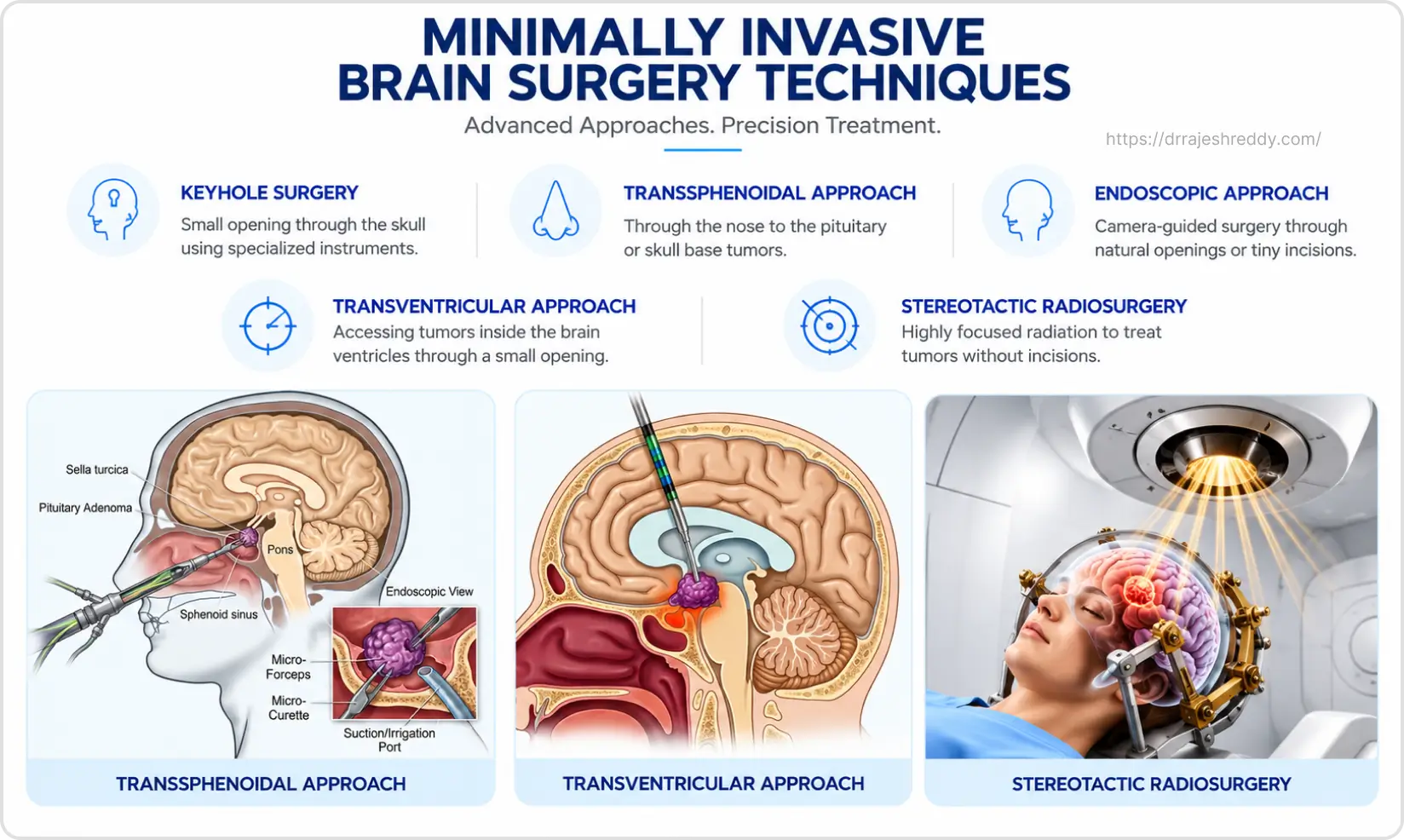 Minimally Invasive Brain Surgery Techniques Overview