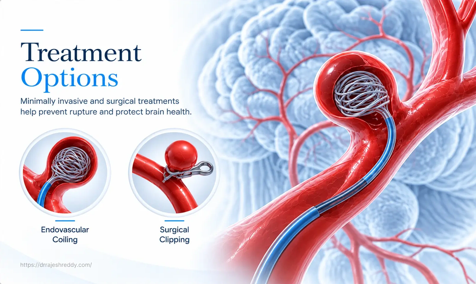 Endovascular Coiling Treatment