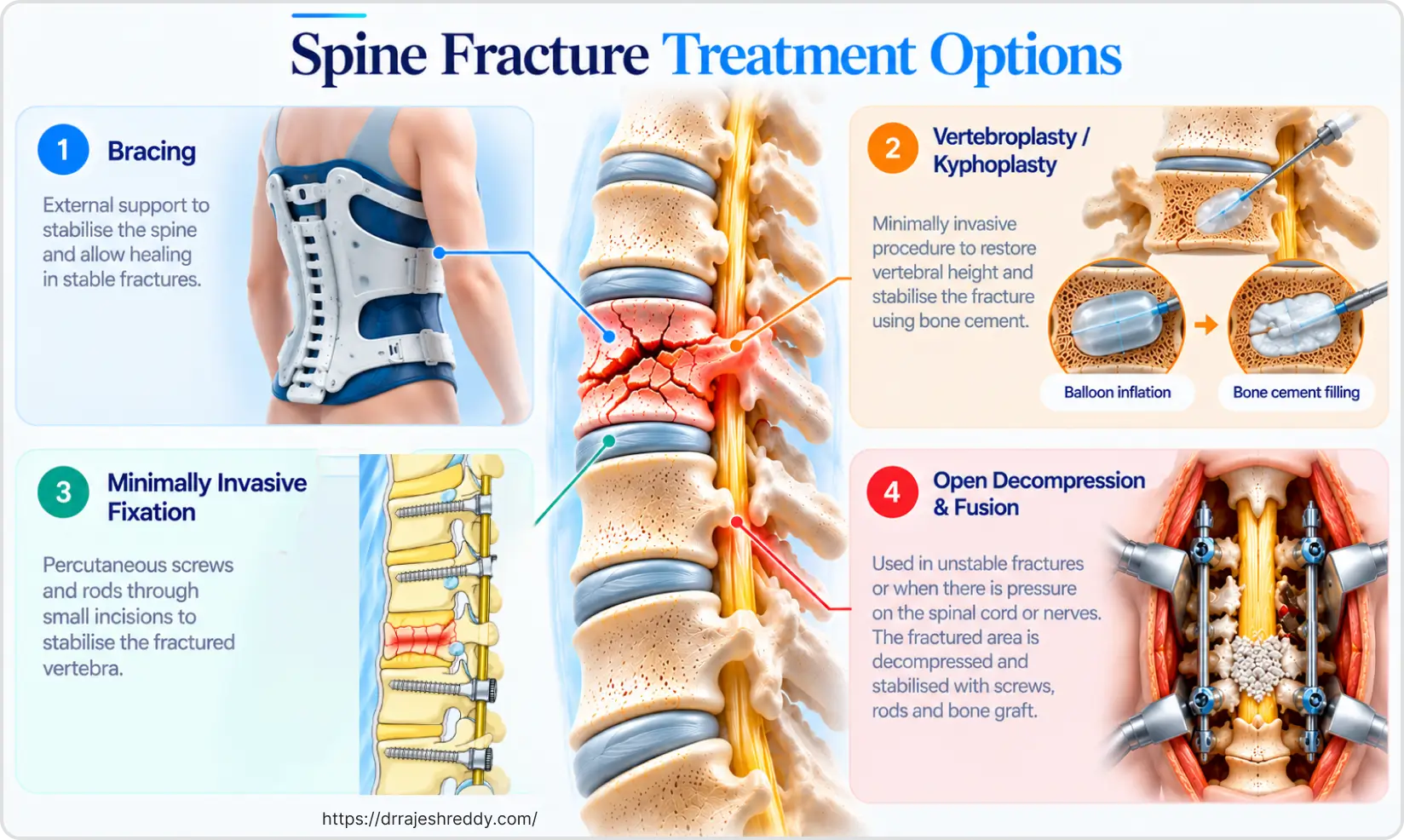 Spine Fracture Treatment Options: A Complete Overview
